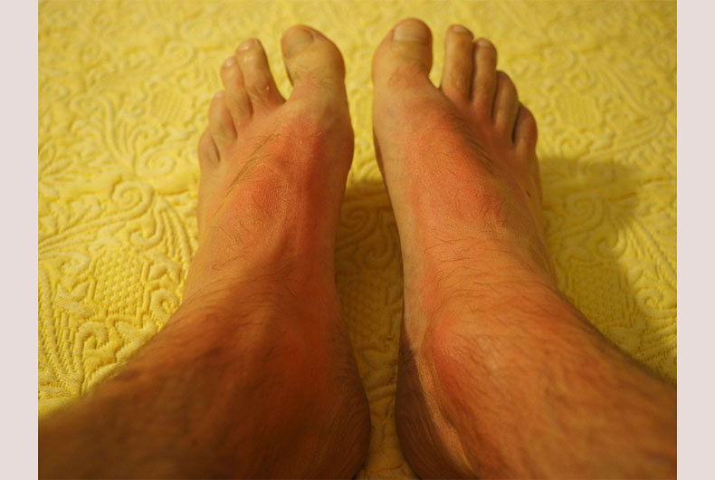 Skin Cancer