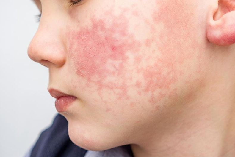 Monkeypox Virus