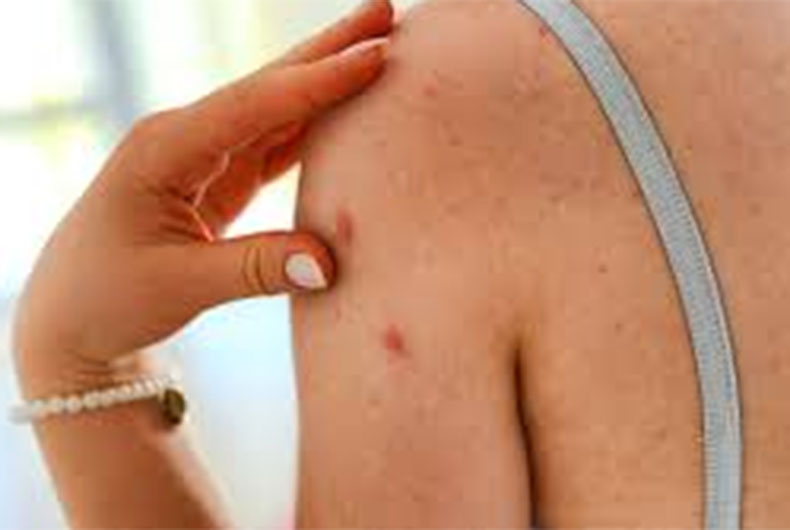 WHO on Monkeypox